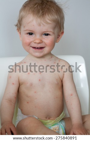 baby sitting on chair with  chicken pox rash, smiling, natural photo