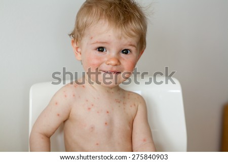 baby sitting on chair with  chicken pox rash, natural photo