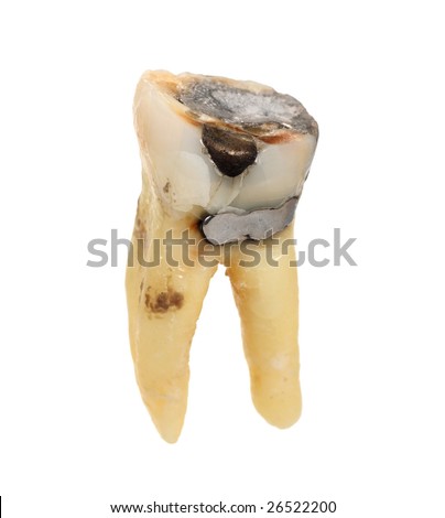 Old tooth with fillings isolated on white