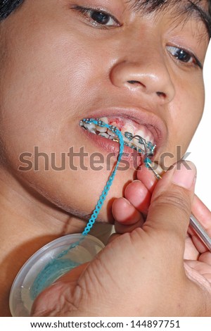 young woman amid dental surgery or braces treatment is done by a dental surgeon isolated on white background