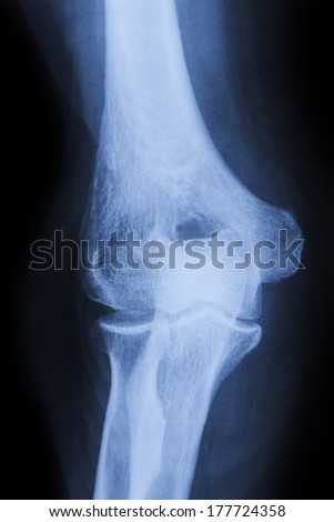 X Ray of a slightly bended elbow joint