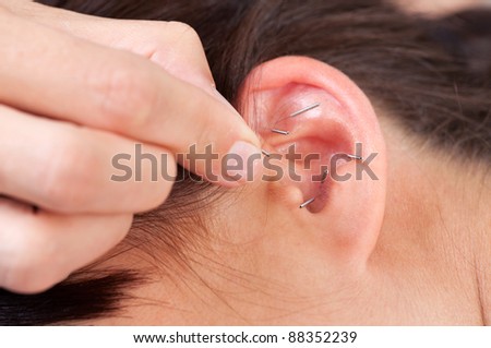 Acupuncture therapist placing needle in ear of patient