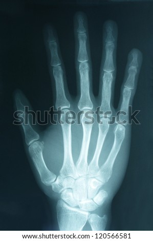 X-ray image of Human right hand