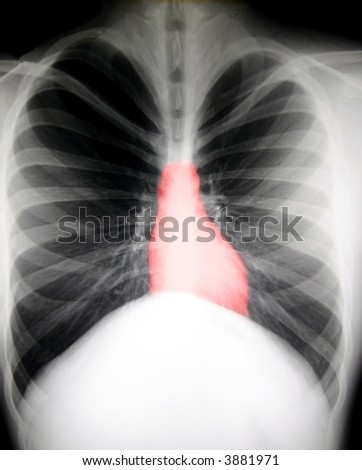 X-ray of chest with red heart