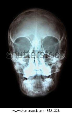 Skull X-ray 2