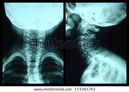 Child neck xray side and back view