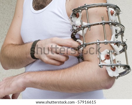 External ring  fixation using  on the  male upper arm  in orthopedic medicine