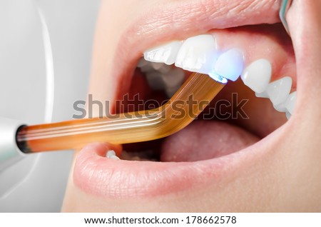 Dentist ultraviolet light pressed on teeth. Close up