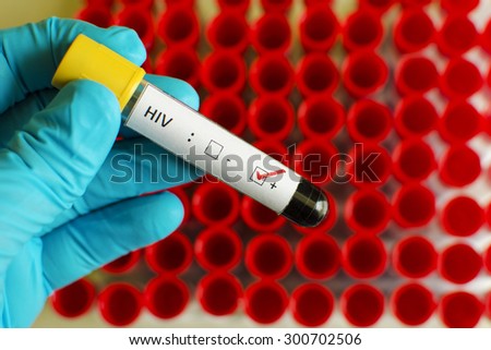 Blood sample with HIV positive