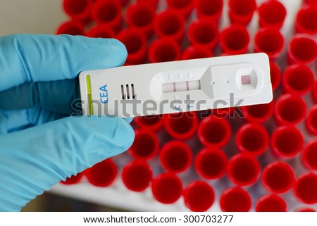 CEA (Carcinoembryonic antigen) testing by using test cassette, the result showed positive (double red line)