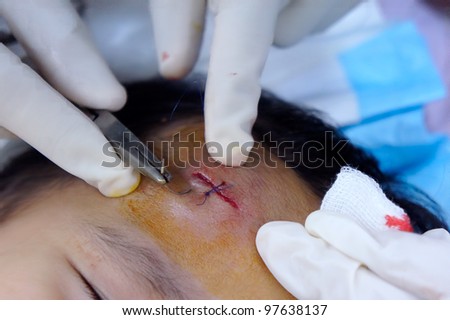 Doctor stitch closing a wound in the forehead during surgery