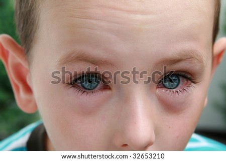Allergic Pink Eye Pictures. contracted pink eye drops
