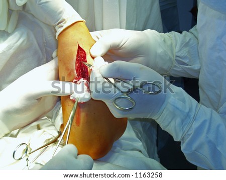 A surgical procedure in an operating room. A moment after incision.