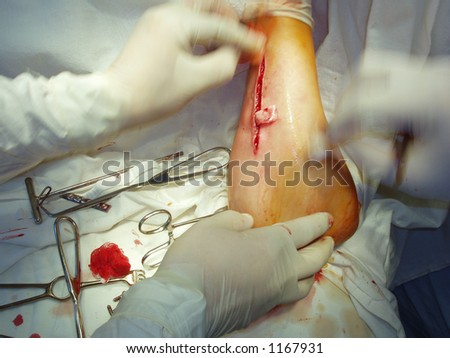  شرح دورة الإسعافات***** Stock-photo-hands-of-surgeons-and-patient-s-arm-moment-before-stitching-operative-wound-1167931