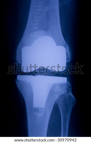 Total knee replacement x-ray front picture