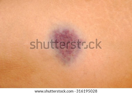 Close up on a bruise on wounded woman leg skin. Gender violence concept