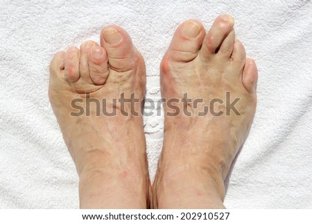 Deformed feet due to medical error,on a white towel