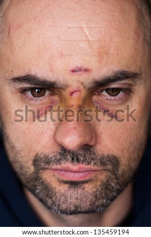 Face of an injured man with wounds and black eyes. Soft focus.