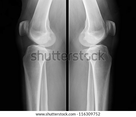 X-ray of human knee