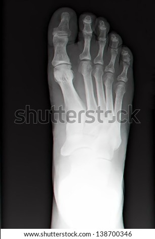human leg bone X-rays