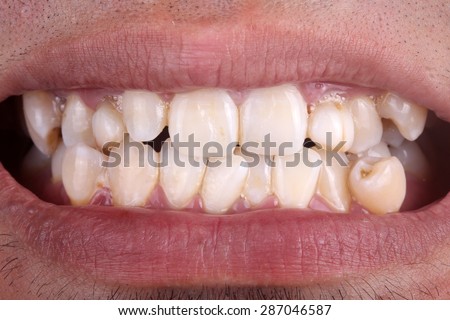 Mouth with crooked teeth