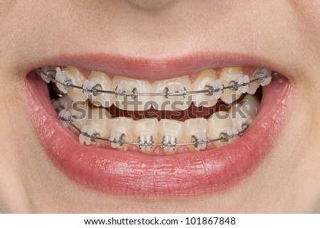 beautiful teeth with perfect oral hygiene