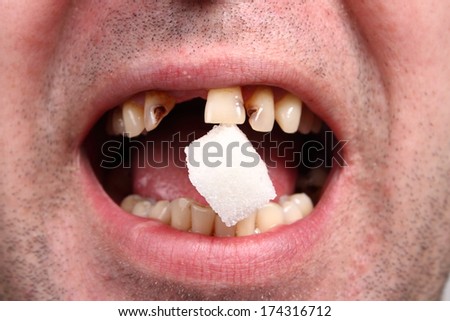 bad teeth, sugar and teeth