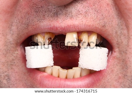 bad teeth, sugar and teeth