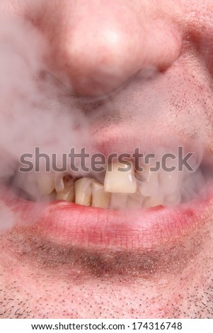 bad teeth, smoker teeth