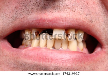 Bad teeth, smoker