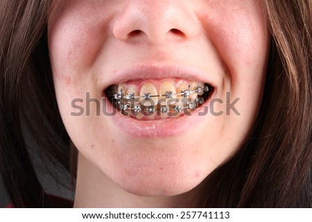 Bad teeth with braces, bad oral hygiene