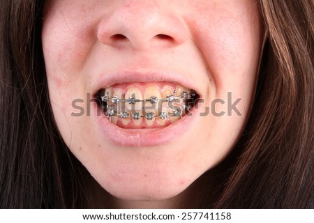 Bad teeth with braces, bad oral hygiene