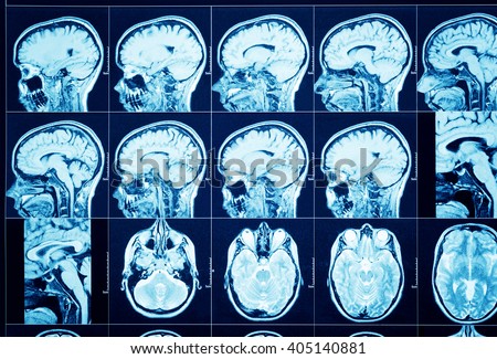 Closeup of a CT scan with brain