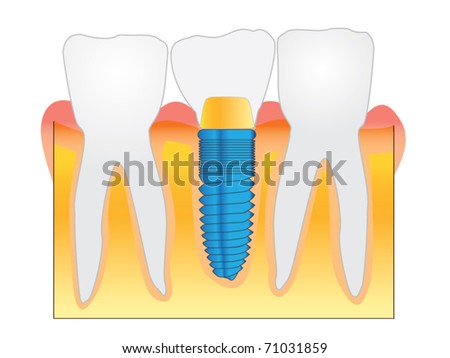 dental implant