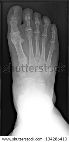 Male x-ray of a fractured right foot senior injury and bone spur on big toe