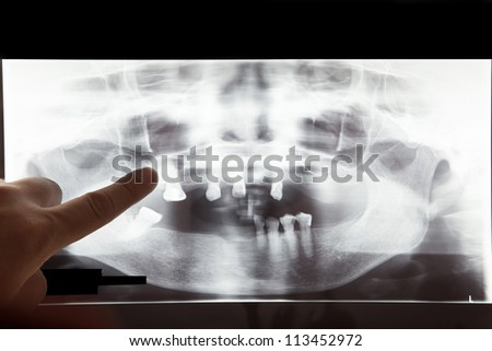 Panoramic dental X-Ray with hands point