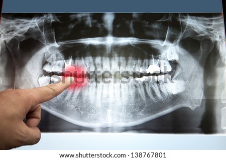 Panoramic dental X-Ray with hands point in Computer screen