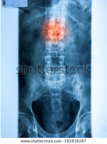 X ray MRI -  Image of Spinal Column Neck pain and Skull Head Stress