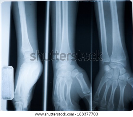 x ray of hands and arms