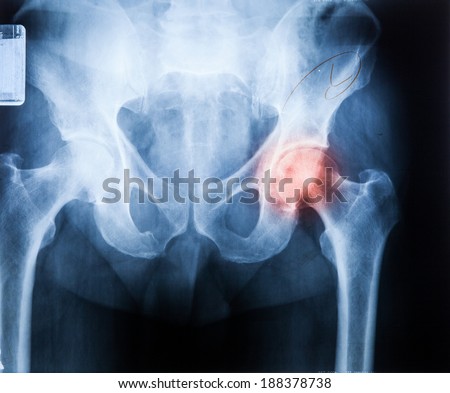 X ray of Hip joint pain bone