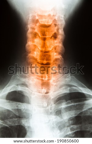 X ray MRI - Image of Spinal Column Neck pain and Skull Head Stress