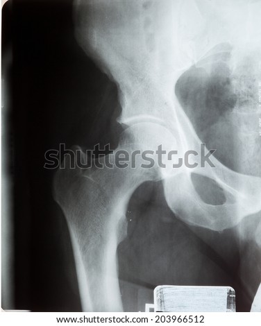 X ray of human Hip joint pain bone