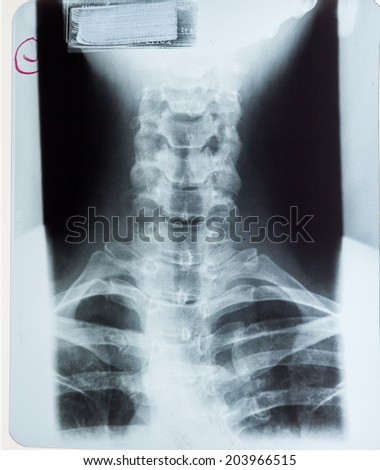 X ray MRI - Image of Spinal Column Neck pain and Skull Head Stress