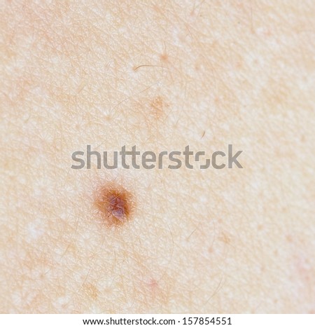 skin mole
