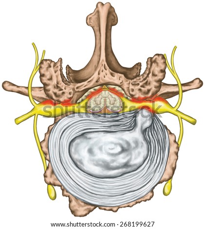 Stenosis, lumbar disk herniation, herniated disc, osteophytes, spondylophytes, intervertebral disk, nervous system, nerve root, spinal cord, arthrosis,  anatomy of human skeletal and nervous system
