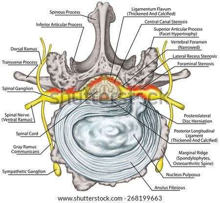 Stenosis, lumbar disk herniation, herniated disc, osteophytes, spondylophytes, intervertebral disk, nervous system, nerve root, spinal cord, arthrosis, anatomy of human skeletal and nervous system