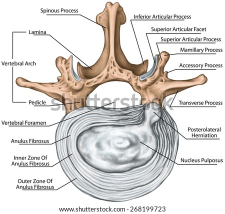 Lumbar disk herniation, herniated disc, lumbar vertebra, lumbar spine, intervertebral disk, anulus fibrosus, nucleus pulposus, vertebral bones, vertebra, anatomy of human skeletal system,superior view