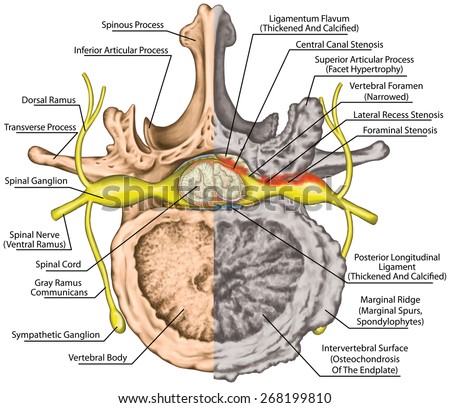 Stenosis, central lateral stenosis, nervous system, spinal cord, lumbar spine, nerve root, advanced uncovertebral arthrosis, degenerative changes vertebra, osteophytes, spondylophytes, osteoarthritis