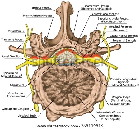 Stenosis, central lateral stenosis, nervous system, spinal cord, lumbar spine, nerve root, advanced uncovertebral arthrosis, degenerative changes vertebra, osteophytes, spondylophytes, osteoarthritis