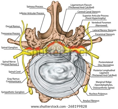 Stenosis, lumbar disk herniation, herniated disc, osteophytes, spondylophytes, intervertebral disk, nervous system, nerve root, spinal cord, arthrosis, anatomy of human skeletal and nervous system
